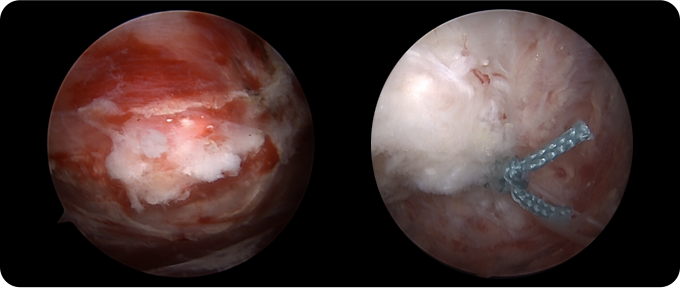 인대 봉합술&재건술