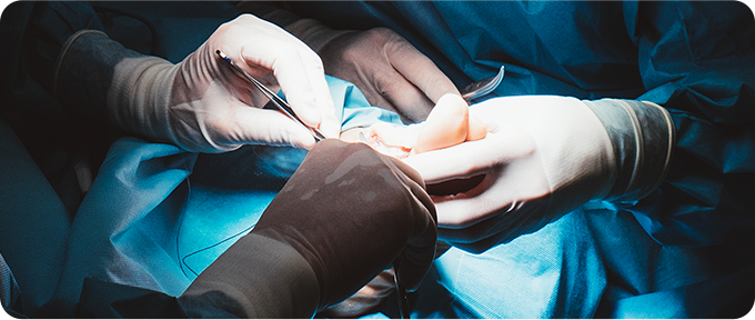 무지외반증 수술