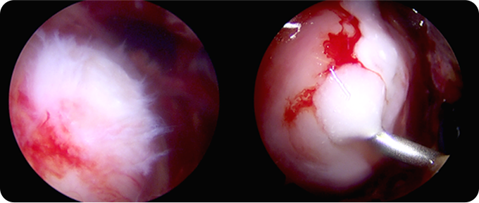 아킬레스건 봉합술&재건술