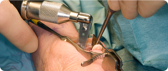 건초막 절개술 사진