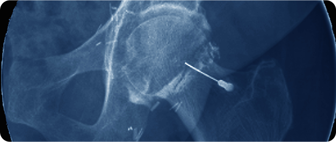 재생주사치료 치료 사진