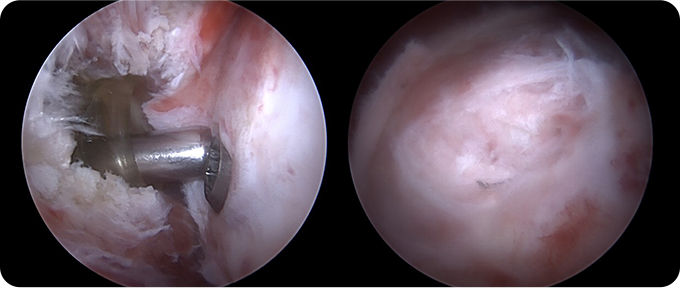 최소절대 관절내시경 치료 사진