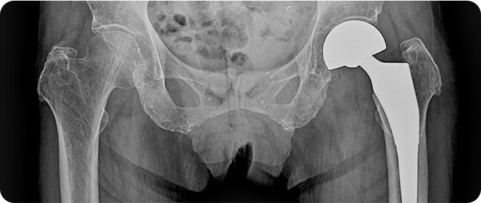 인공관절 수술 치료 사진