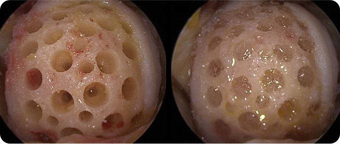 자가 줄기세포 이식술 치료 사진