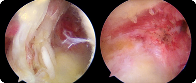 최소절대 관절내시경 치료 사진