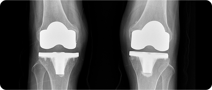 인공관절 수술 치료 사진