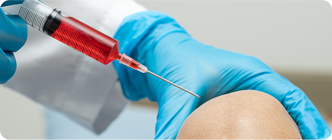 자가 줄기세포 주사치료 사진