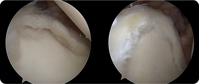 연골 봉합술&절제술 치료 사진