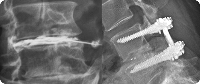 척추 감압술&고정술 사진