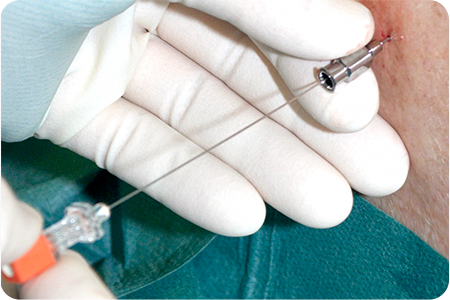 줄기세포 채취하는 사진