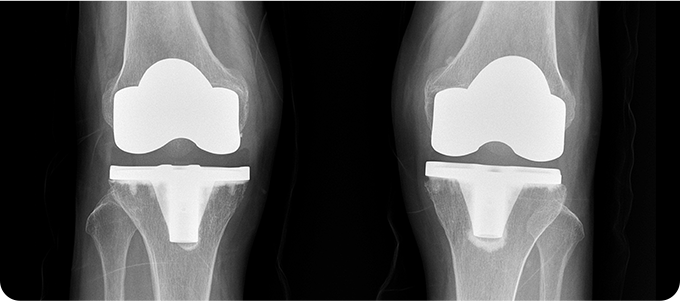 전치환술 관련 이미지