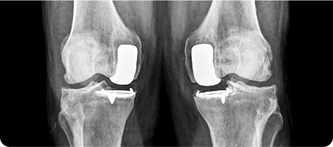 부분치환술 관련 이미지