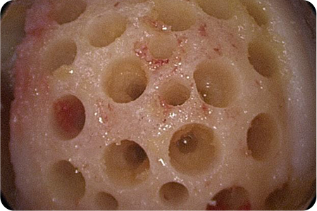 연골 구멍 내기하는 사진