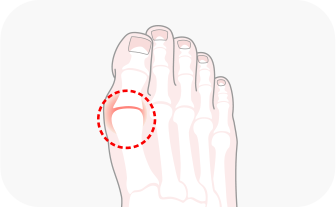 발 20도 이하의 변형 이미지