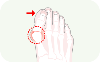 발 20도 이하의 변형 이미지