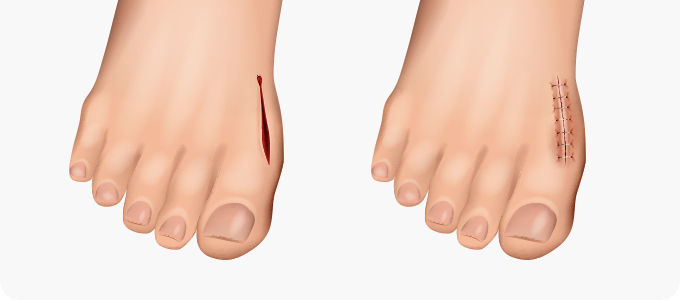 기존 절개술 이미지