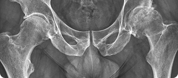 부분치환술 관련 이미지