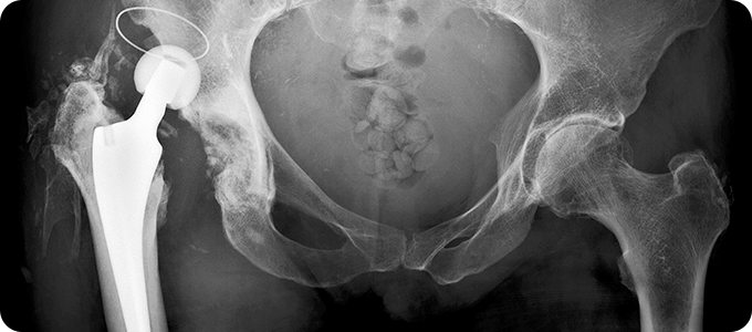 인공관절 치환술 사진