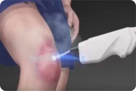 신장분사 치료 사진