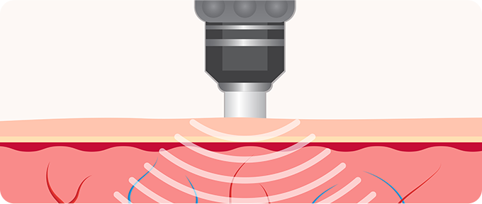 체외충격파 치료 사진