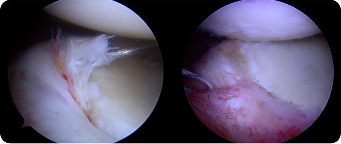 최소절대 관절내시경 치료 사진