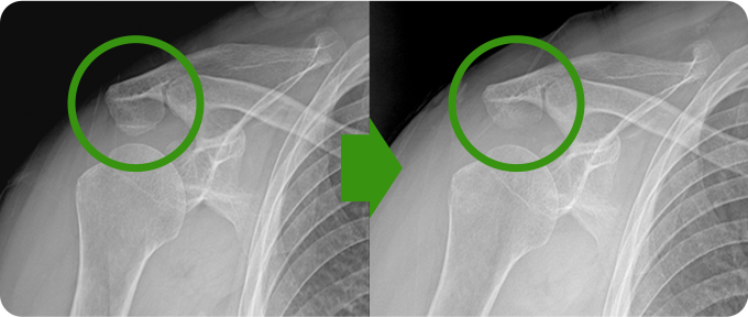 견봉성형술&감압술 치료 사진