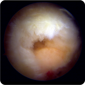 전층파열(소파열)인 모습의 회전근개