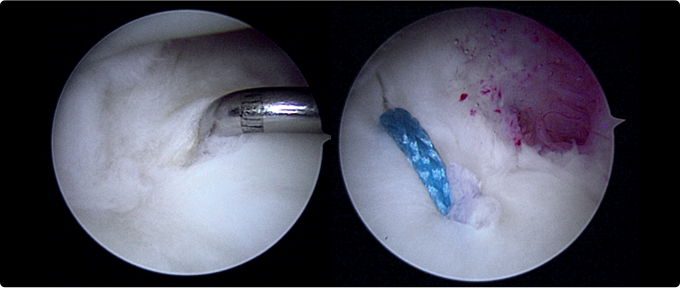 최소절개 관절내시경 치료 사진