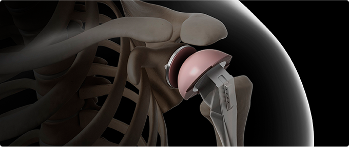 인공관절 수술 치료 사진