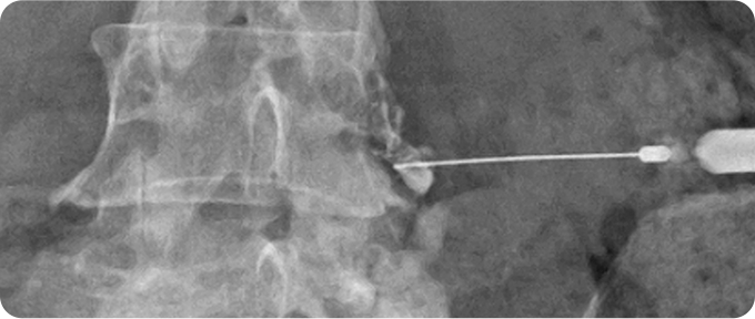 신경차단술 사진