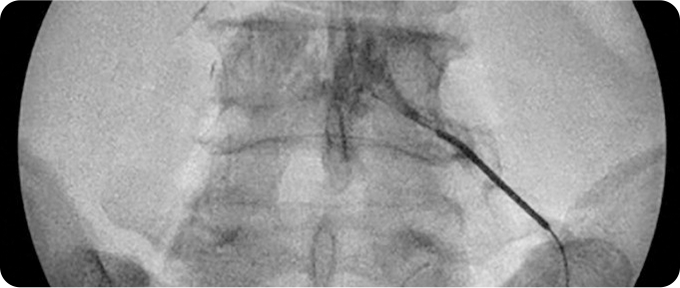 신경성형술 사진