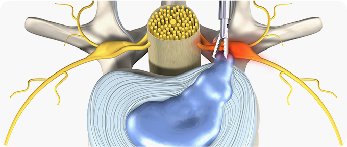 최소절개 척추내시경 사진