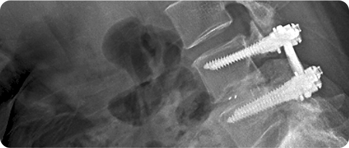 척추 고정술 사진