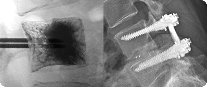 척추 성형술&고정술 사진